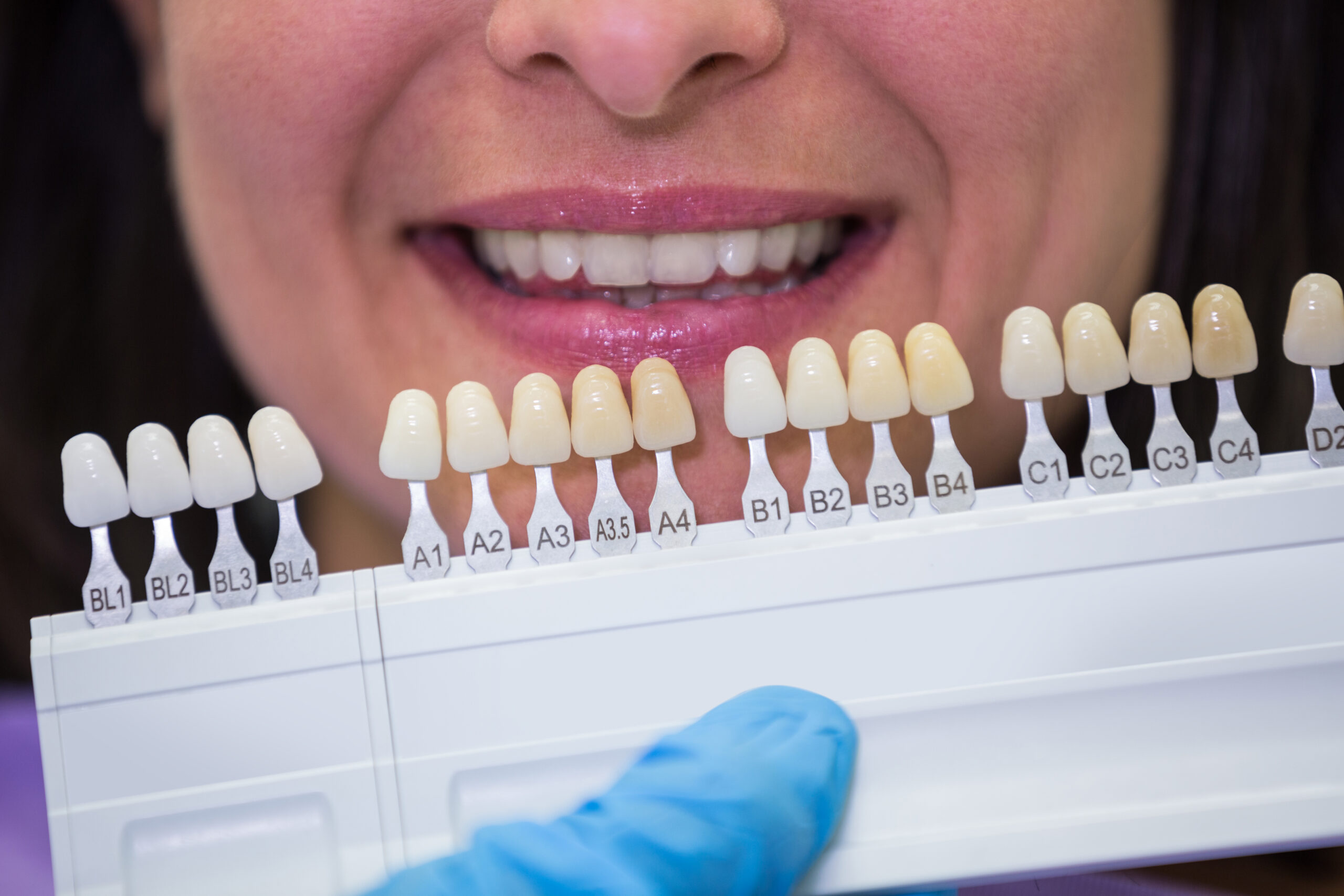 The Process of Getting Porcelain Veneers Lewisville TX: What to Expect