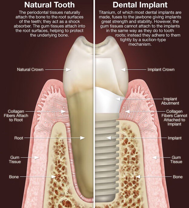 5 Things You Should Know Before Getting a Dental Implant